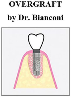 OVERGRAFT BY DR. BIANCONI trademark