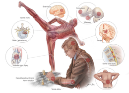 BRAIN INJURY CONCUSSION SPORTS INJURY WHIPLASH  BRAIN / SPINE TUMOR STROKE ARTHRITIS / JOINT INJURY SPINAL CORD INJURY CARPAL TUNNEL SYNDROME NERVE IRRITATION TENNIS ELBOW BONA KIRN BACK PAIN trademark